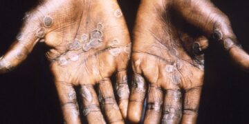 Mpox: What you need to know about the latest public health emergency