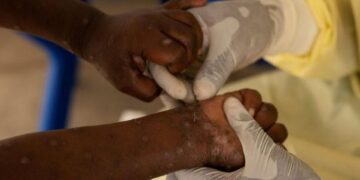 Uganda confirms two more cases of mpox